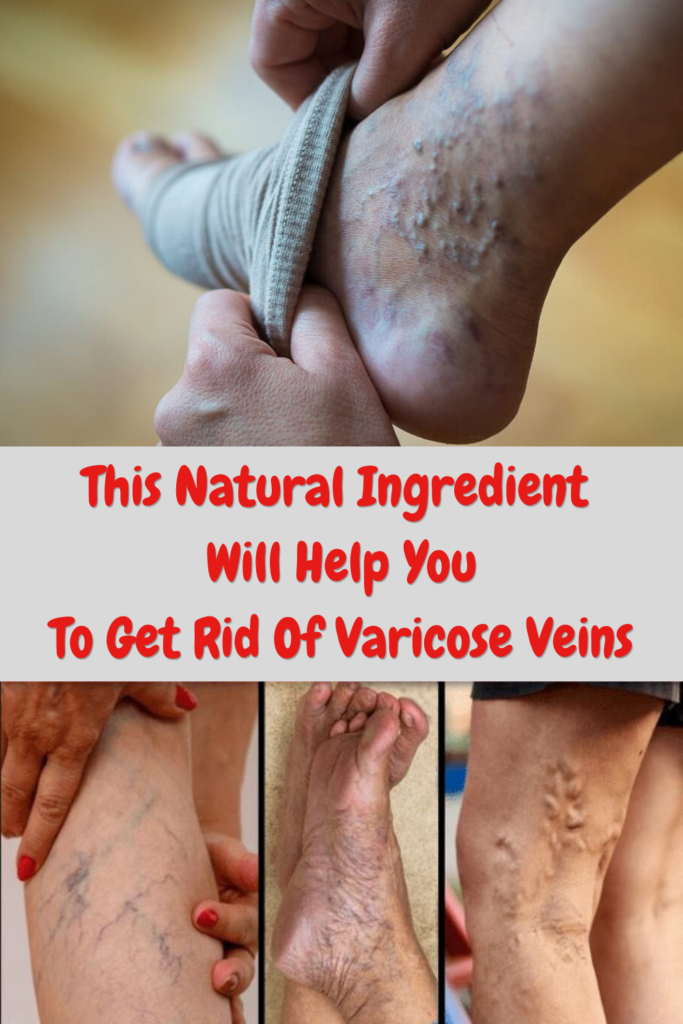 This Natural Ingredient Will Help You Get Rid of Varicose Veins
